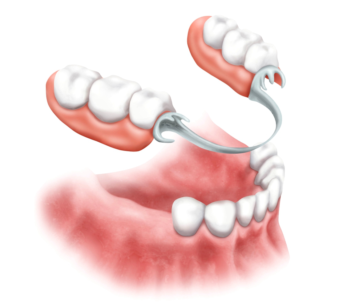 Протезирование одного зуба: особенности и способы