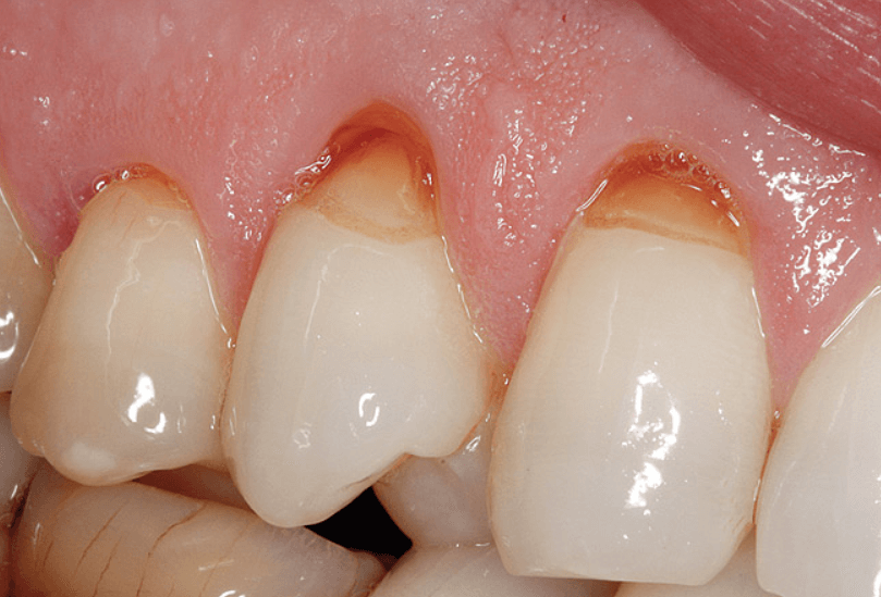 Клиновидный дефект, 23 зуб